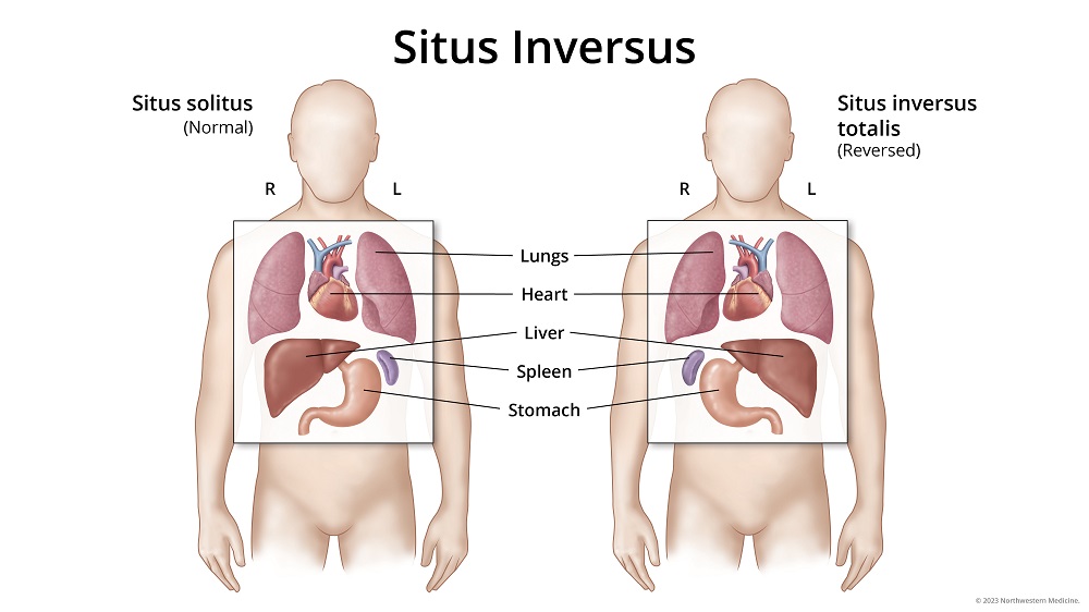 double-lung-transplant-on-a-patient-with-flipped-organs